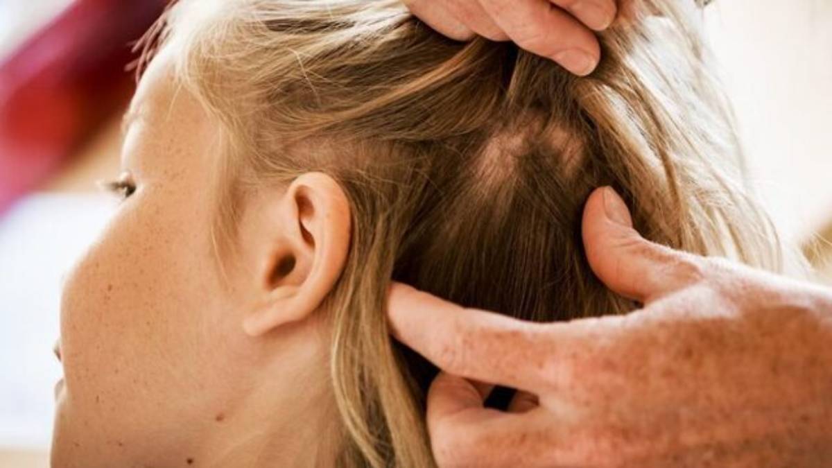 Nederlandse moeder weigert luizen van dochter te behandelen: “Ik dood geen enkel insect”