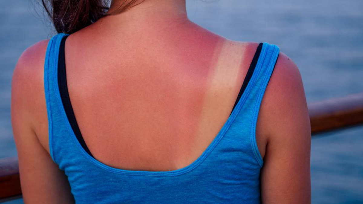 Zondag enorm hoge zonkracht: ‘Vermijd de zon en smeer je goed in’