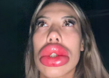 Jongedame verminkt na mislukte lipvergroting