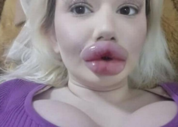 Andrea (23) kan niet zonder fillers: “Ik ben veel knapper met grote lippen”