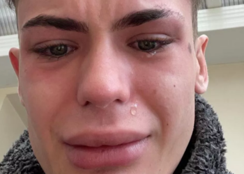 Jack (24) haalt nieuwe tanden uit Turkije: “Nu ben ik helemaal verminkt”