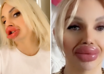 Vienna (24) wil de grootste lippen ter wereld: “Eten en drinken is nu wel lastig”