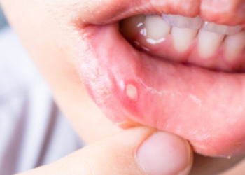 Gezondheidsexpert deelt dé oplossing tegen aften: “Zo kom je er makkelijk en snel vanaf”