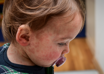 Mazelenuitbraak in West-Brabant: “Vooral ongevaccineerde kinderen getroffen”