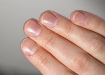 Let op: Longkanker kan je vaak al herkennen aan je vingernagels