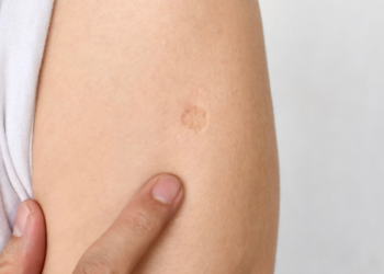 Weet jij de waarheid achter het kleine litteken op de linker bovenarm? Dit is de ware betekenis!