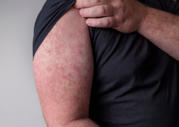 Waarschuwing! Mazelenuitbraak in Nederland: Hoe herken je de symptomen op tijd?