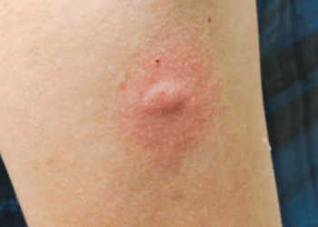 Extreme reactie op muggenbeten? Dit kan er écht aan de hand zijn!