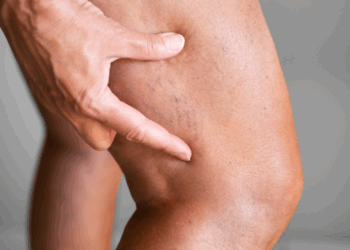 Let op! Deze 5 voetklachten kunnen wijzen op diabetes zonder dat je het weet