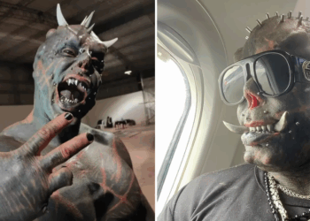 Zo zag Michel, de meest gemodificeerde man ter wereld, er vroeger uit: “Onherkenbaar”