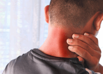 Waarschuwing: Artsen slaan alarm nu gevallen van de zeer besmettelijke ‘bull-neck’ infectie zich snel over Europa verspreiden